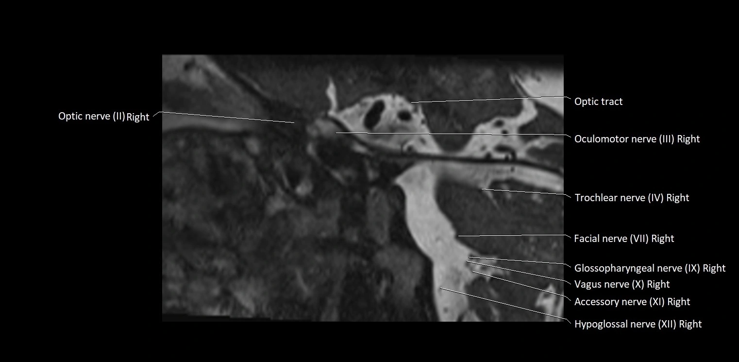 Cranial nerve sagittal anatomy MRI 3T image 41.webp